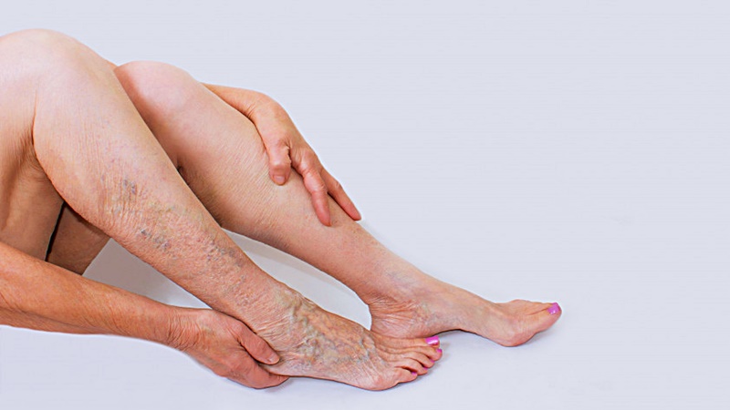 Kiderült az igazság – ezért visszeresedik valójában az emberek lába