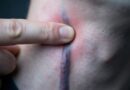 Ezekre a figyelmeztető jelekre figyelj! Súlyos következményei lehetnek, ha elhanyagolod a magas vérnyomás első tüneteit